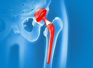 Эндопротезирование крупных суставов