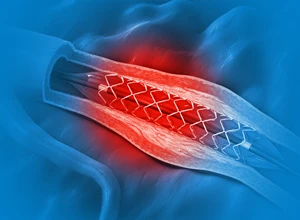 Стентирование коронарных артерий